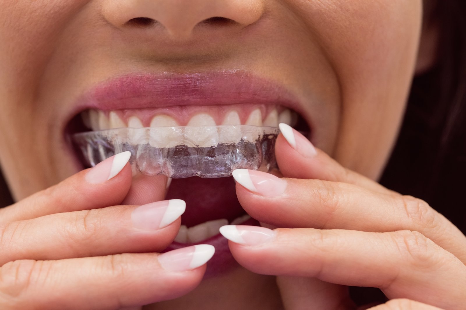 Clear Aligner Treatment at Sure Cure Dental Clinic