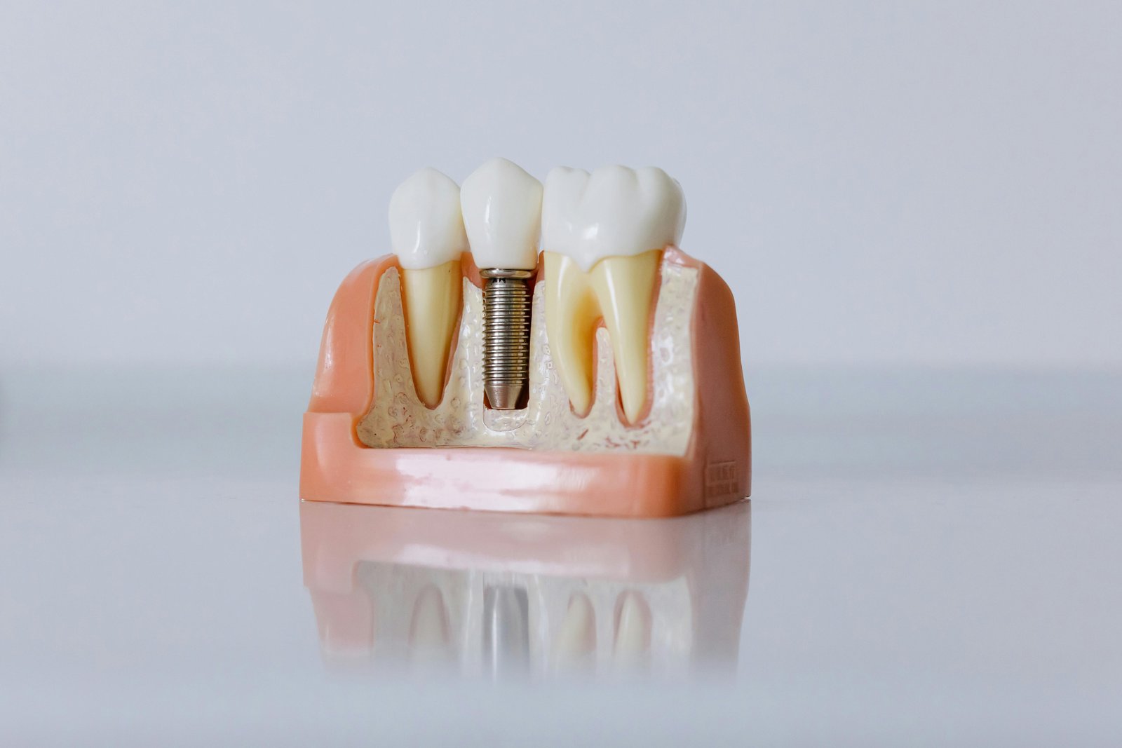 Dental Implants by Expert Implantologist at Sure Cure Dental Clinic