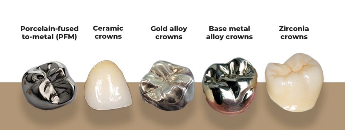 Metal, Zirconia, and Ceramic Caps at Sure Cure Dental Clinic