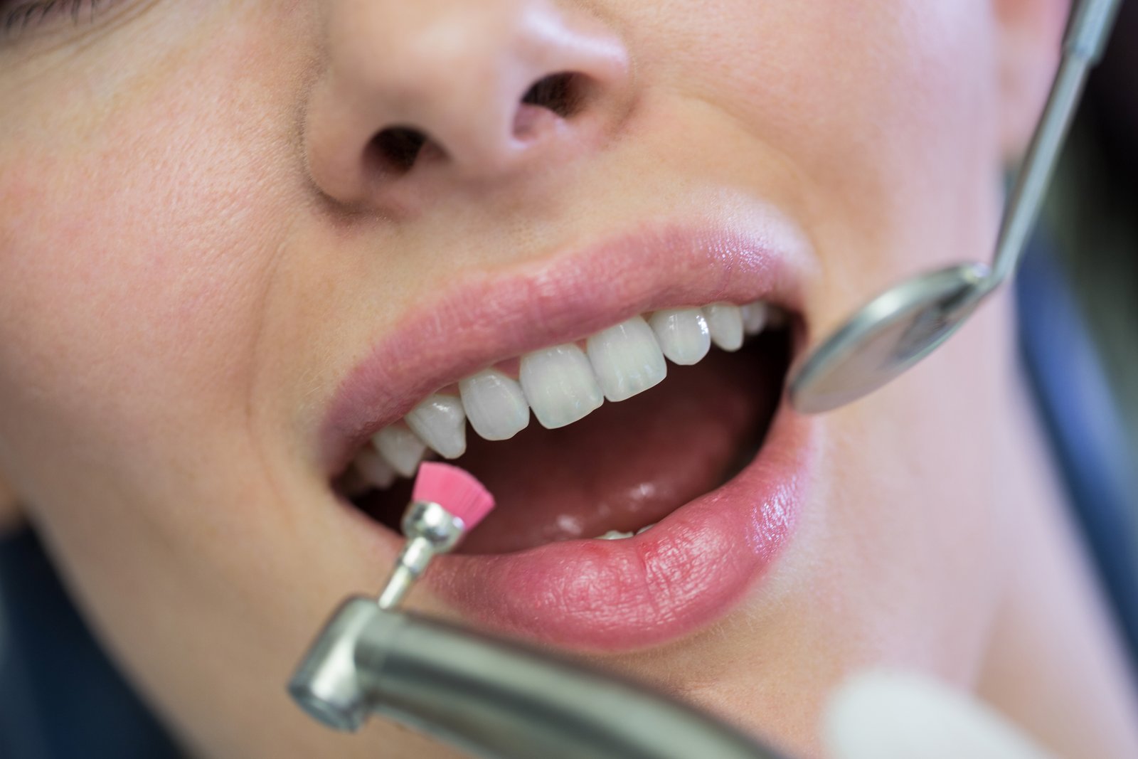 Teeth Cleaning, Polishing and Bleaching at Sure Cure Dental Clinic