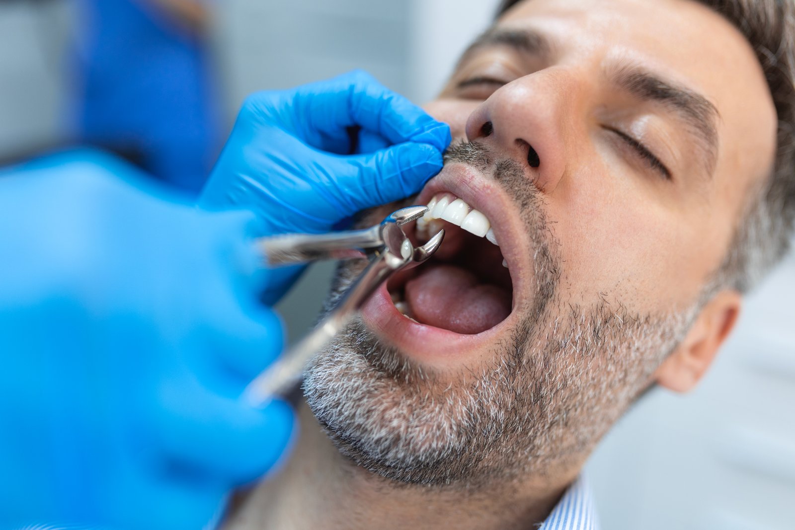 Painless Tooth Removal at Sure Cure Dental Clinic
